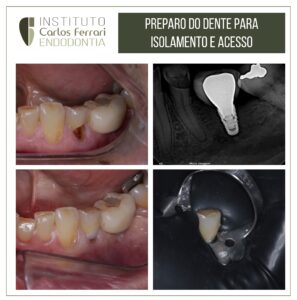 Read more about the article Preparo do dente para isolamento e cirurgia de acesso.