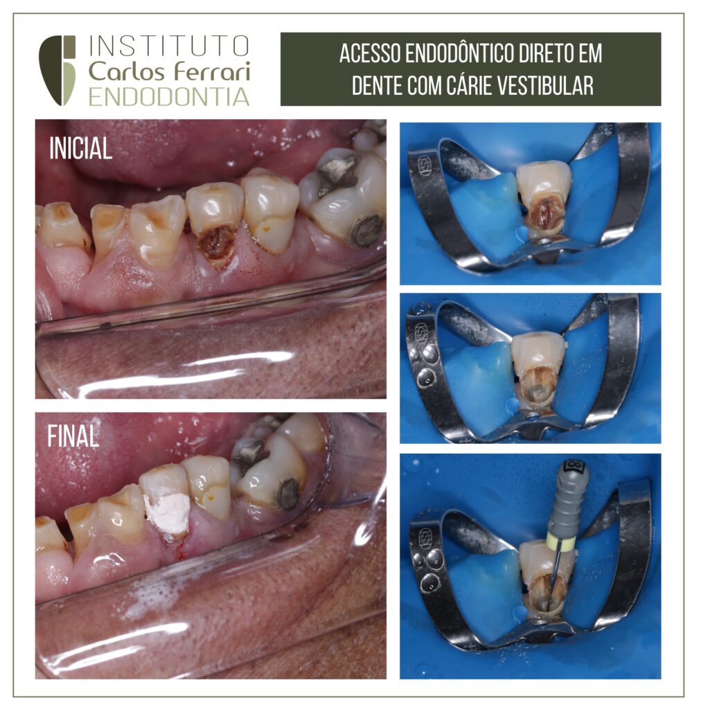 Read more about the article Direct access surgery on a tooth with buccal caries.