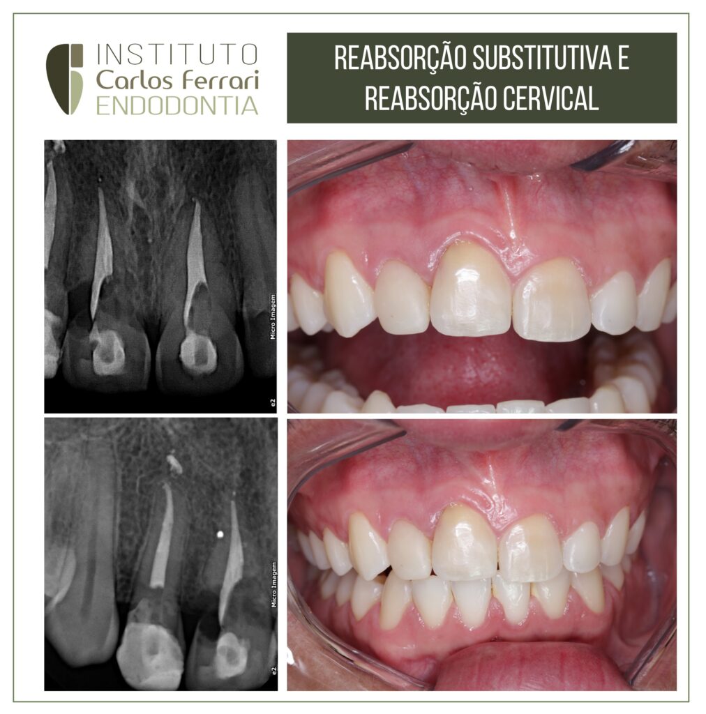 Read more about the article Reabsorção substitutiva e reabsorção cervical.