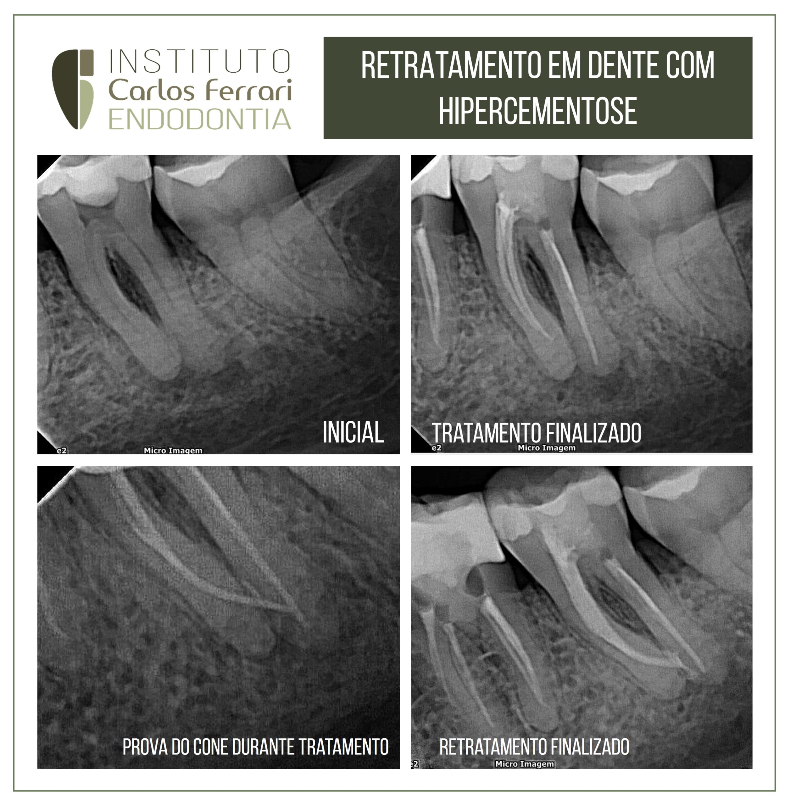 You are currently viewing Retratamento em dente com hipercementose.