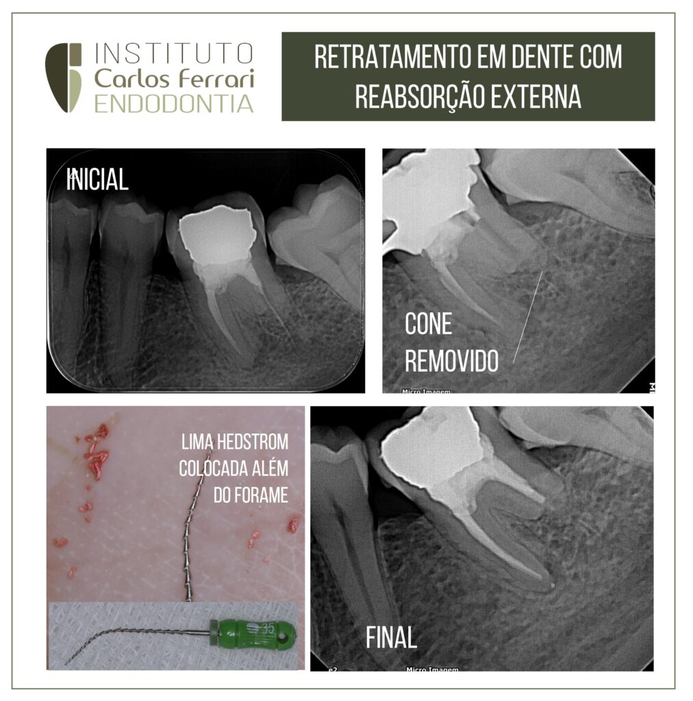 Read more about the article Retratamento em dente com reabsorção externa.