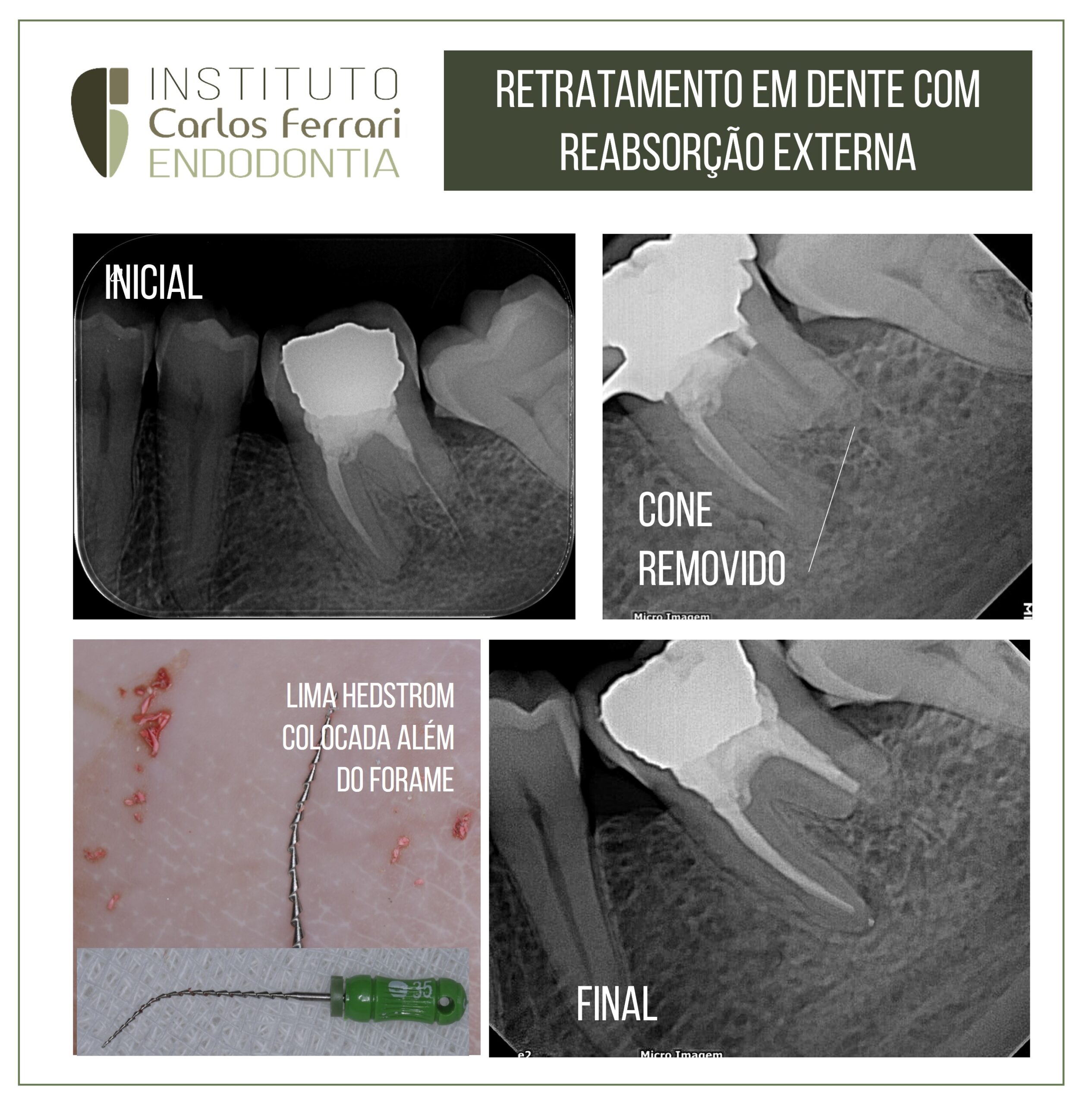 You are currently viewing Retratamento em dente com reabsorção externa.