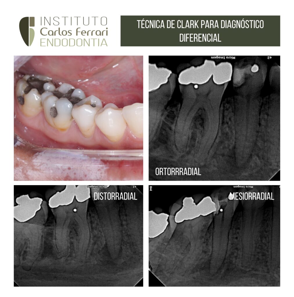 Read more about the article Clark's technique for observing periapical lesions.
