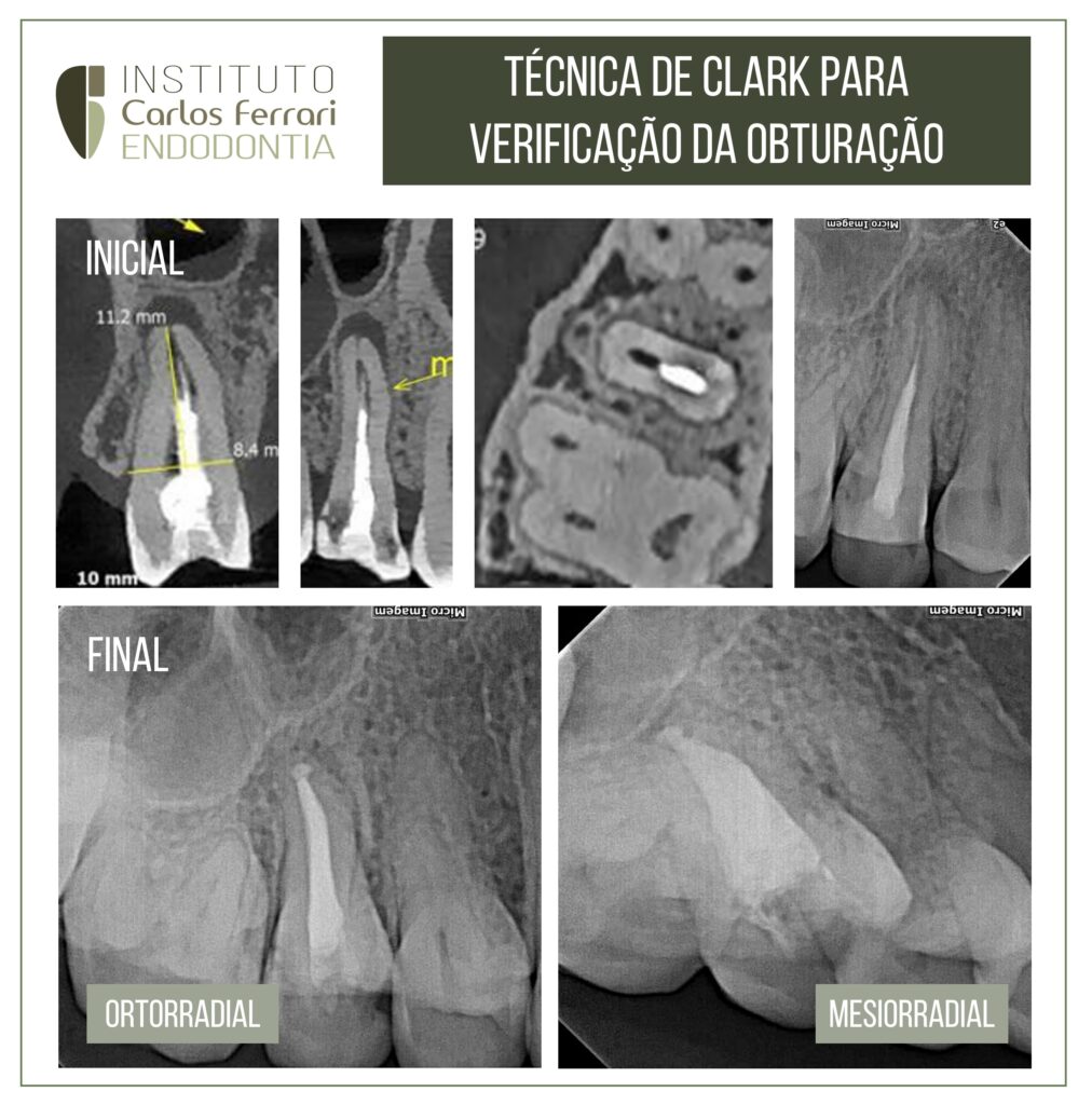 Read more about the article Clark's technique for endodontic obturation.