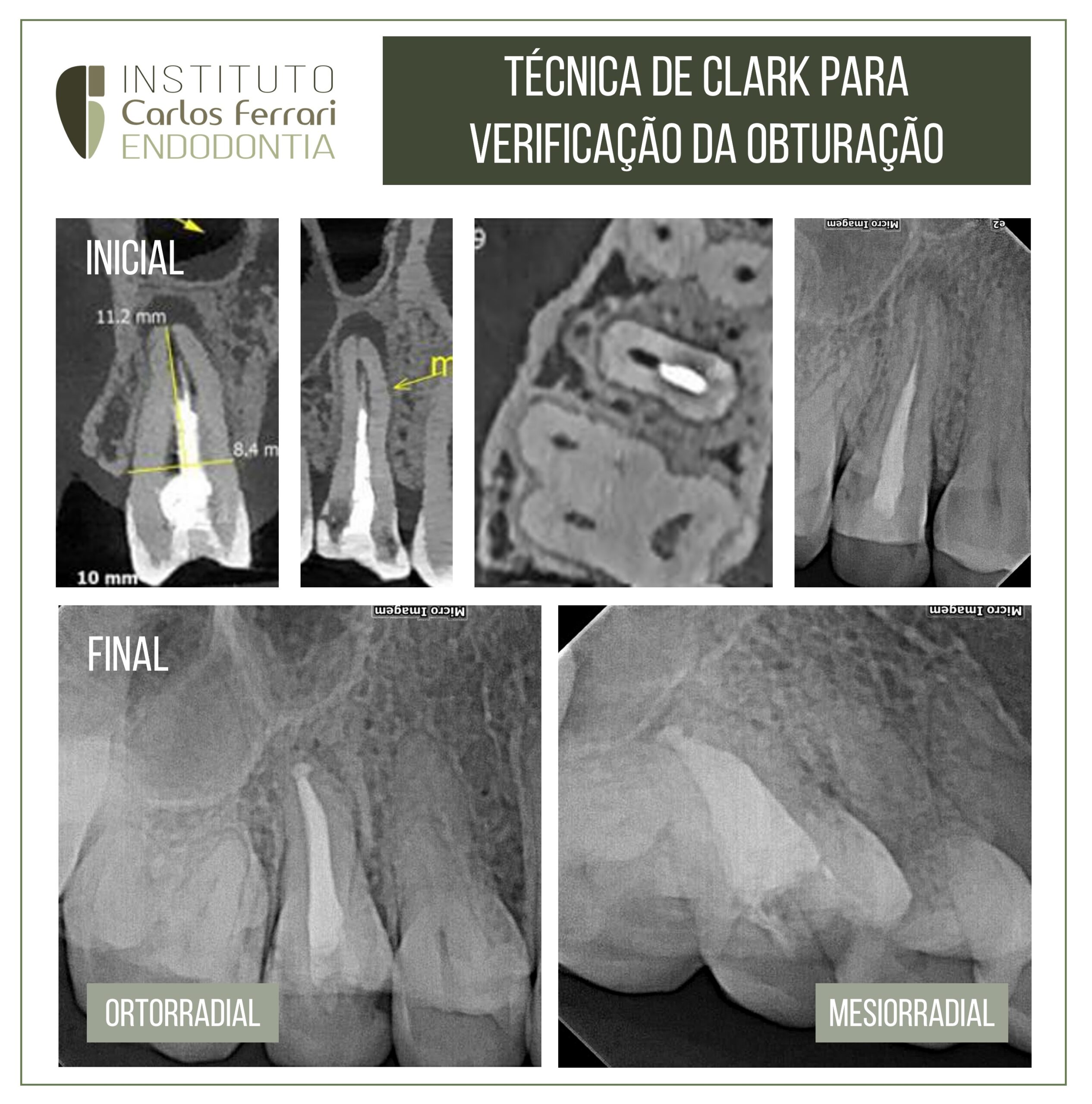 You are currently viewing Clark's technique for endodontic obturation.