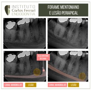 Read more about the article Técnica de Clark para observação de lesão periapical.