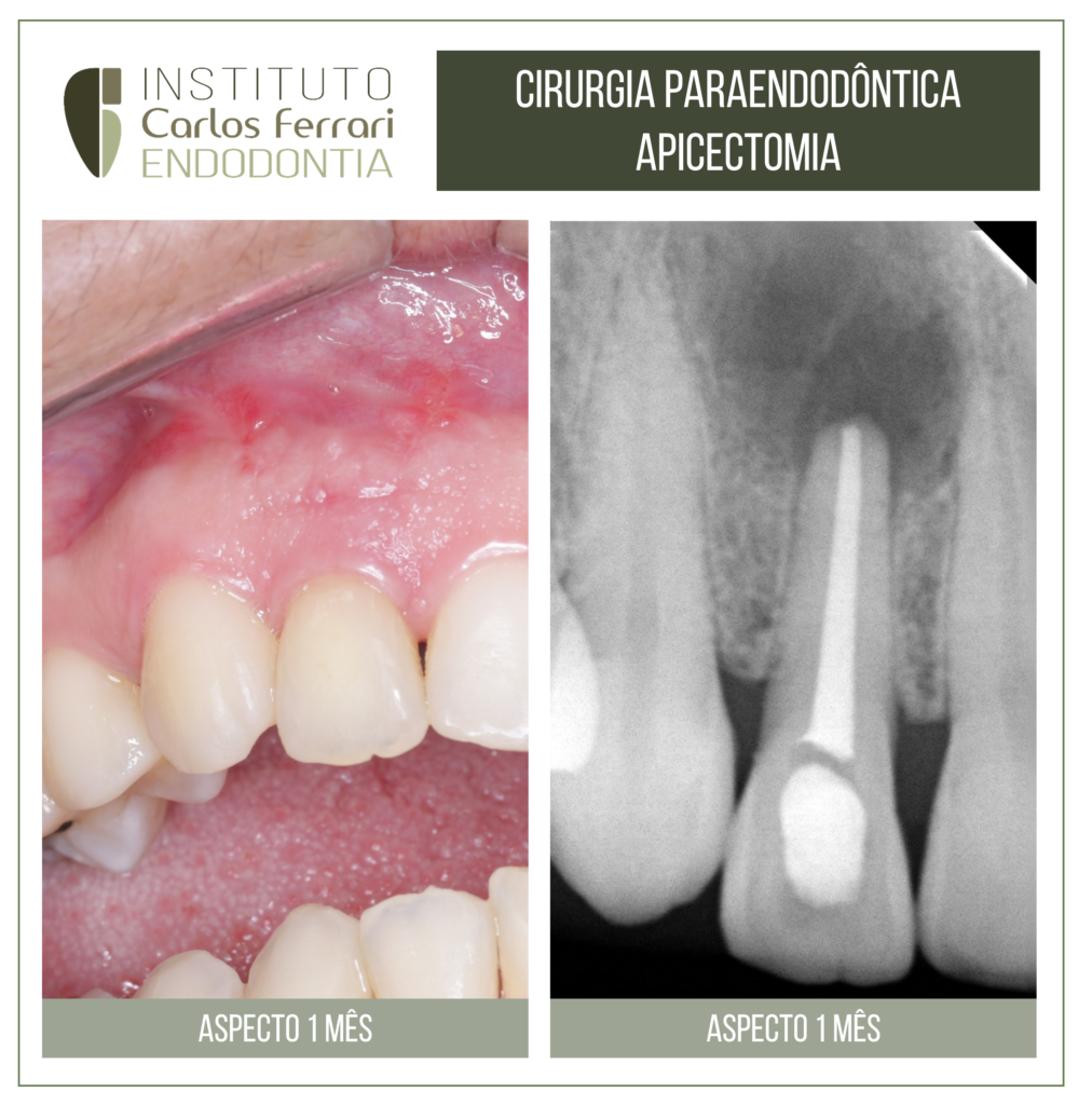 Read more about the article Apicectomia em cirurgia paraendodôntica.