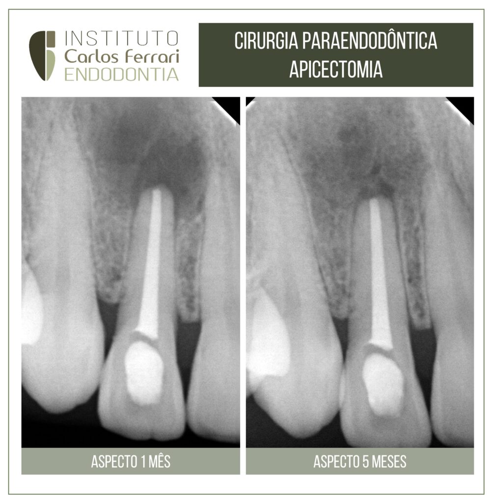 Cirurgia paraendodôntica