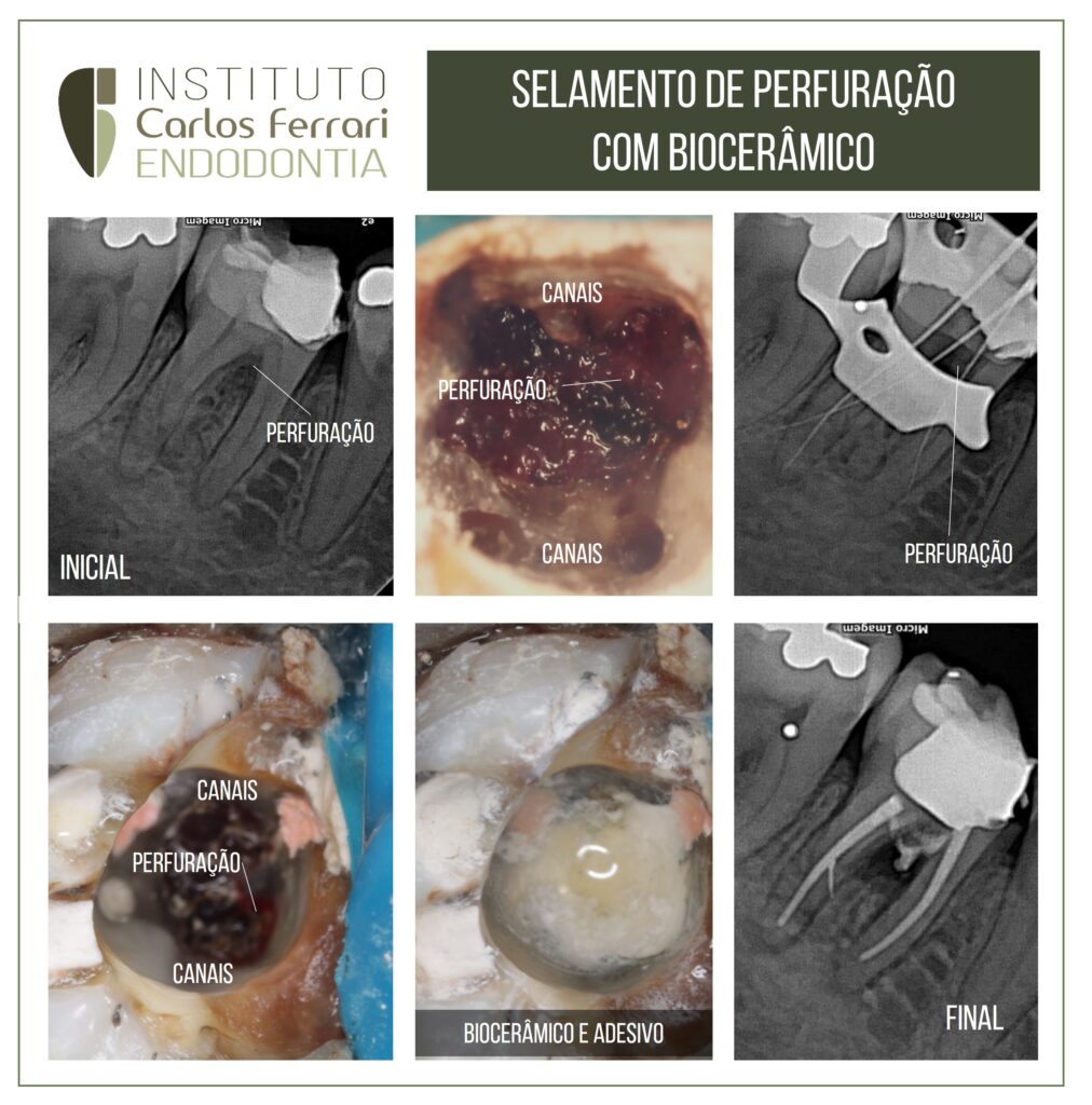 Read more about the article Selamento de perfuração de furca com biocerâmico.