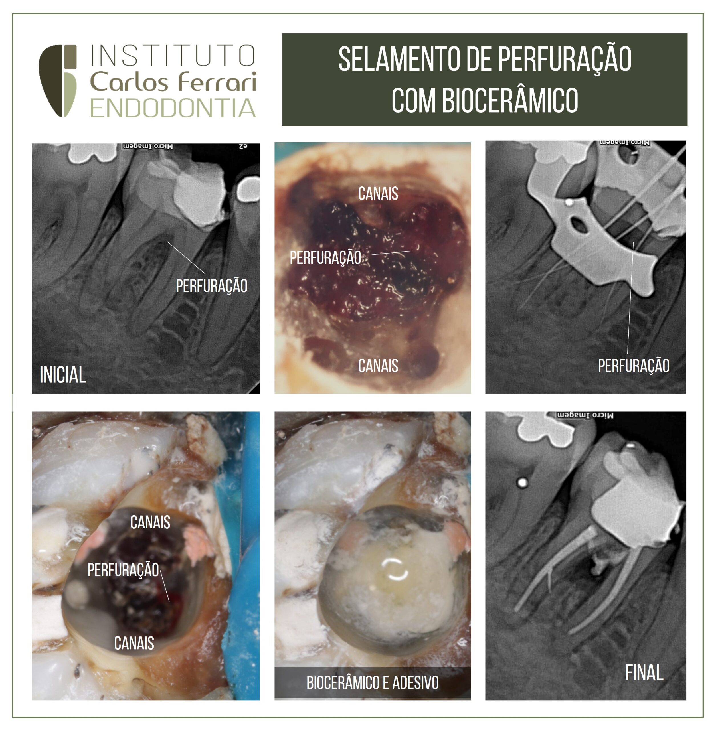 You are currently viewing Selamento de perfuração de furca com biocerâmico.