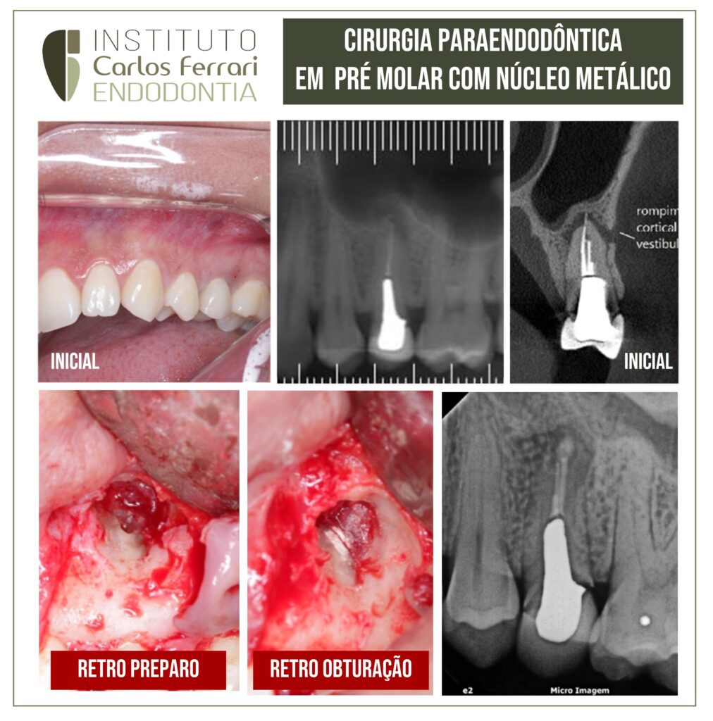 Read more about the article Paraendodontic surgery on a pre-molar with a metal retainer.