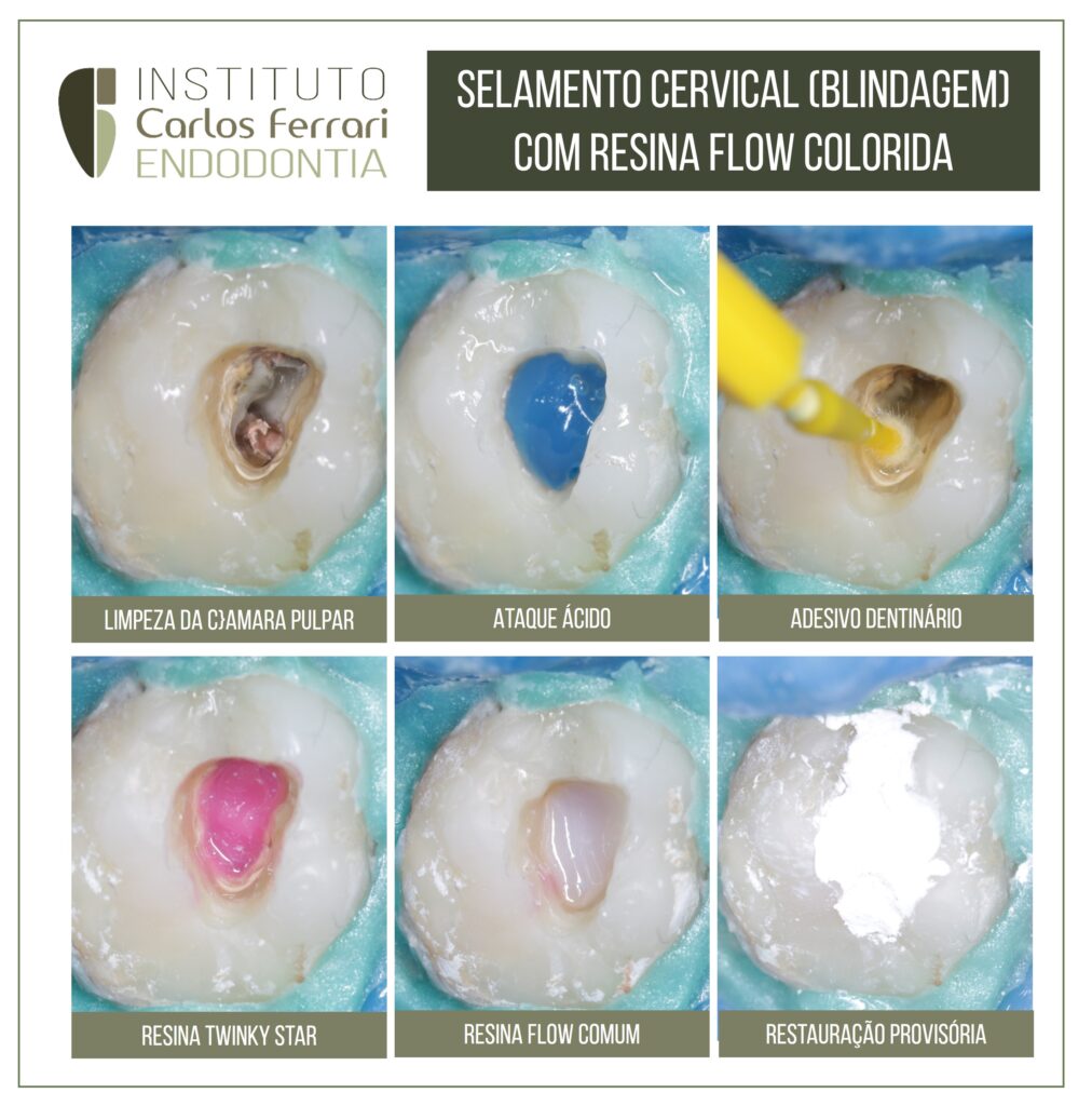 Read more about the article Endodontic shielding with pediatric resin.