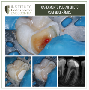 Read more about the article Capeamento pulpar direto com biocerâmico.