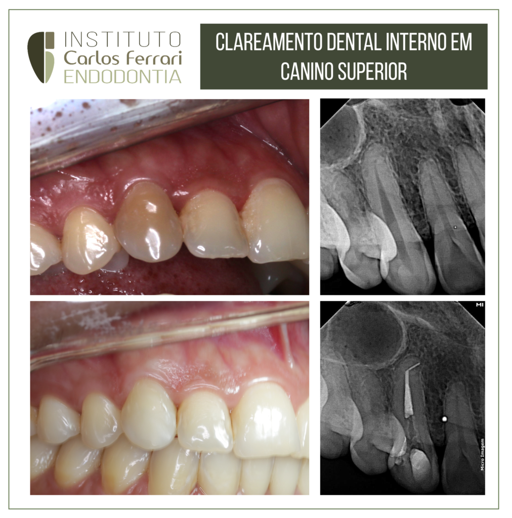 Más información sobre el artículo Blanqueamiento dental interno.