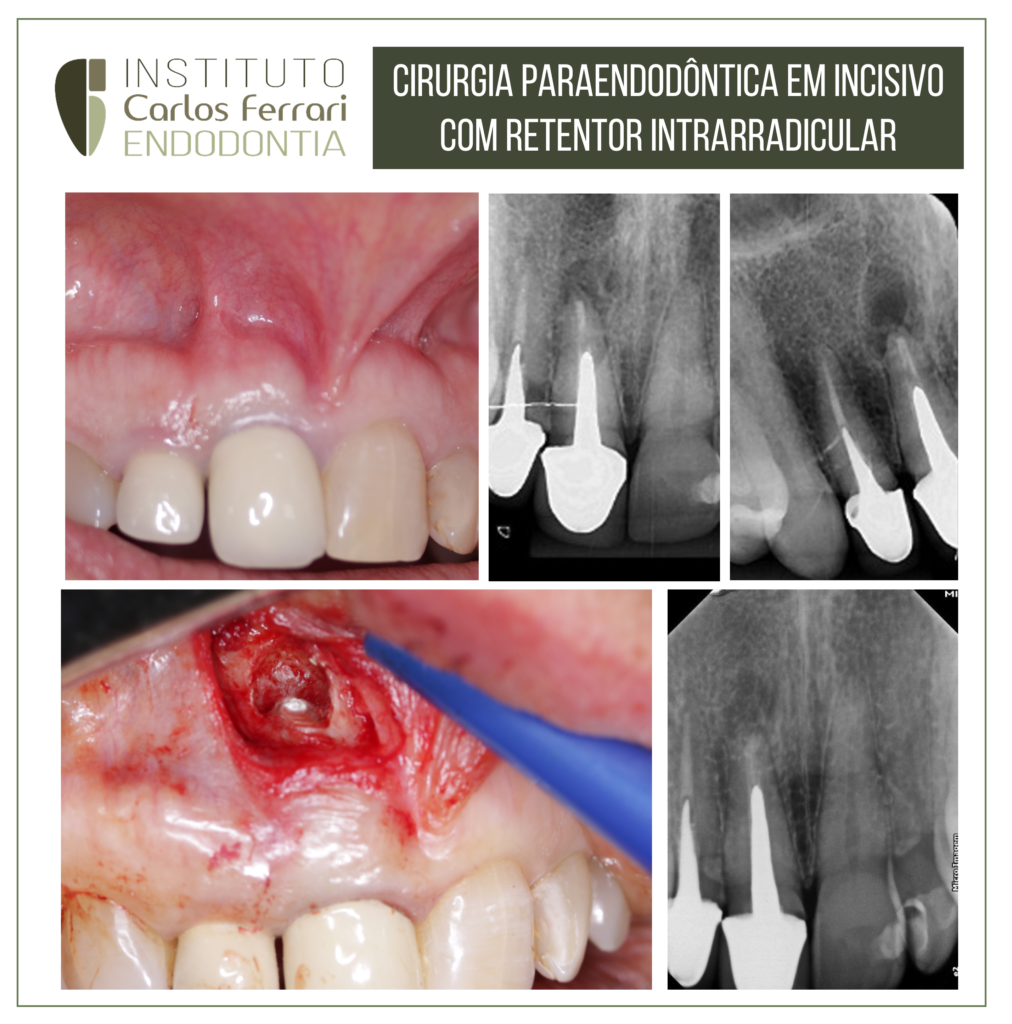 Read more about the article Paraendodontic surgery on a tooth with an intraradicular retainer.