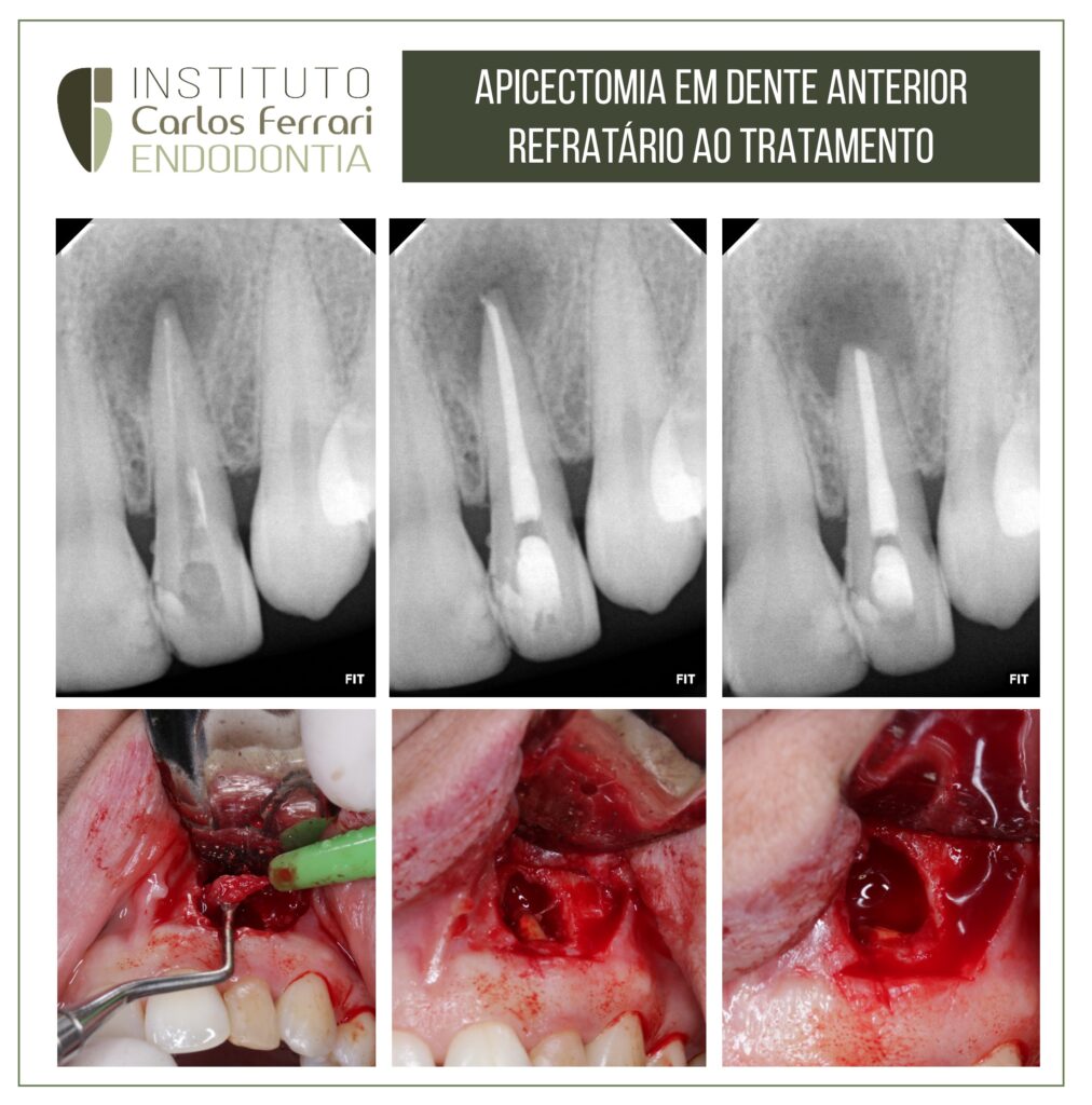 Leer más sobre el artículo Tratamiento endodóntico sin éxito. Apicectomía en cirugía paraendodóntica.