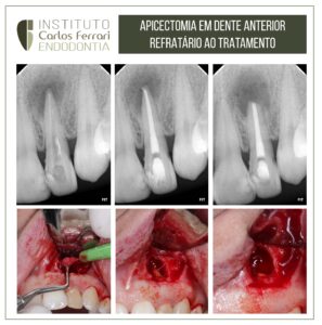 Read more about the article Insucesso no tratamento endodôntico. Apicectomia em cirurgia paraendodôntica.