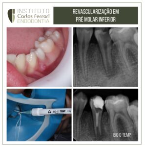 Read more about the article Revascularização em dente com rizogênese incompleta.