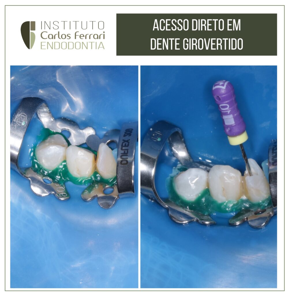 Read more about the article Cirurgia de acesso direto em dente girovertido.