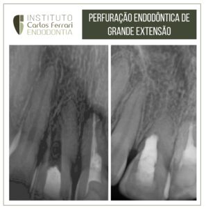 Read more about the article Large endodontic perforation.