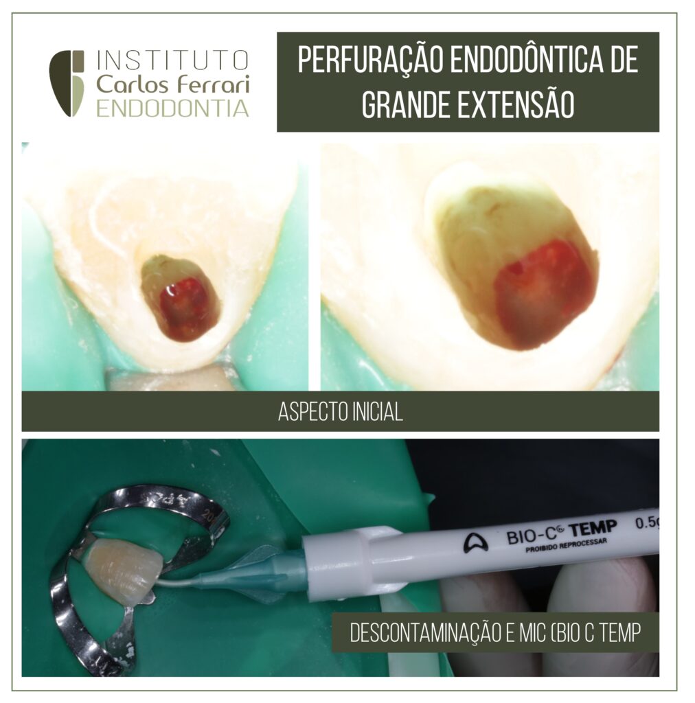 Biocerâmicos na endodontia