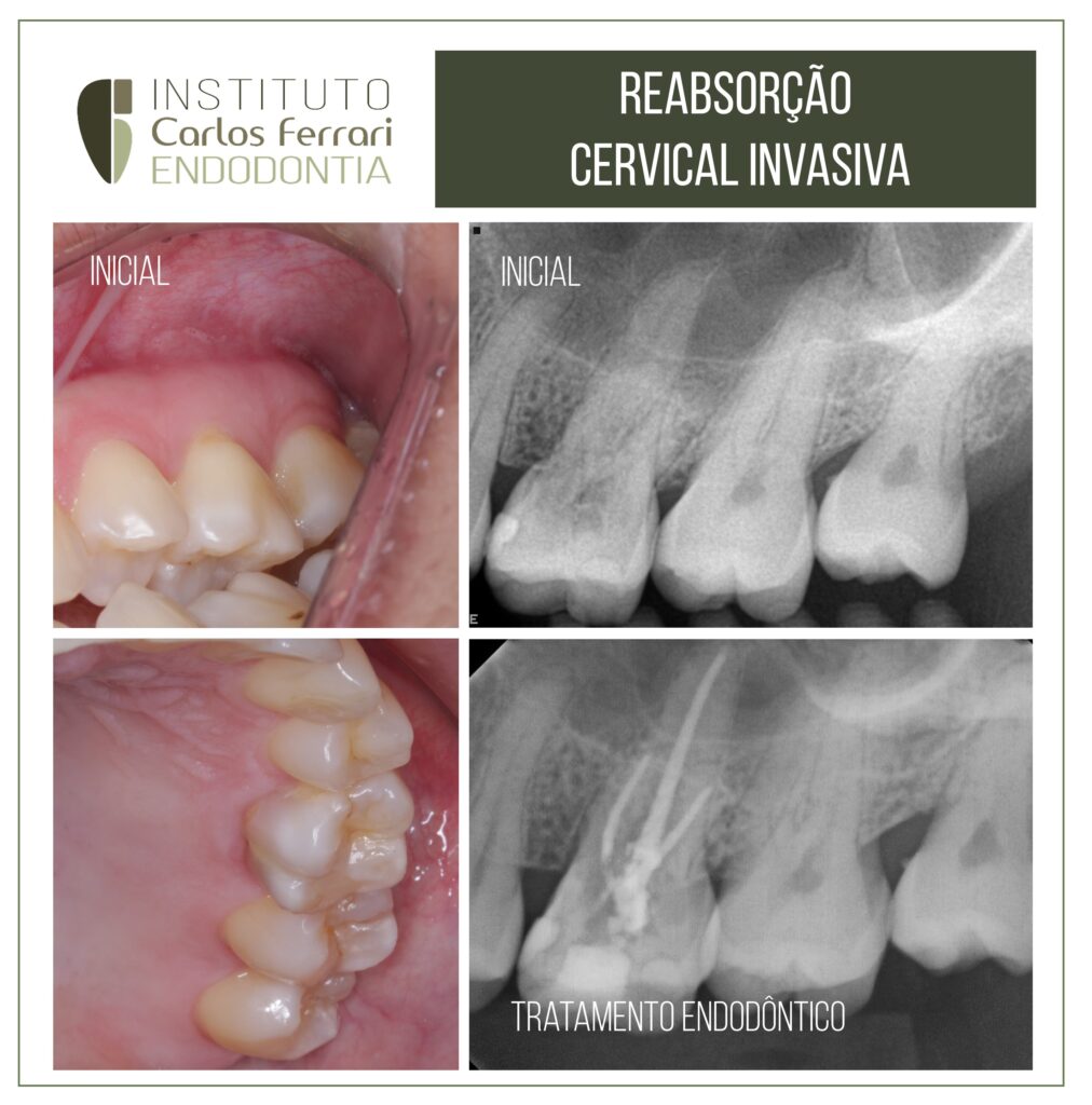 Leer más sobre el artículo Reabsorción invasiva del cuello. Resolución tradicional y quirúrgica.