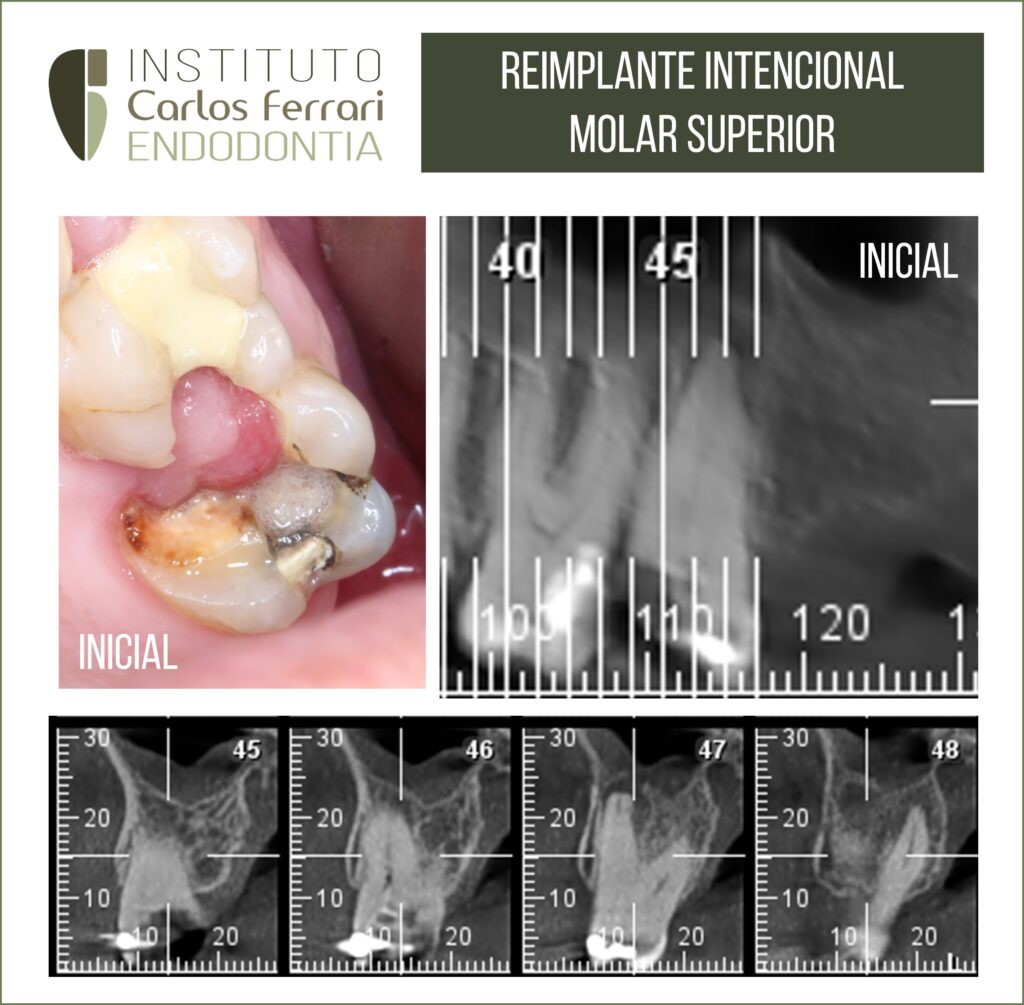 Reimplante intencional