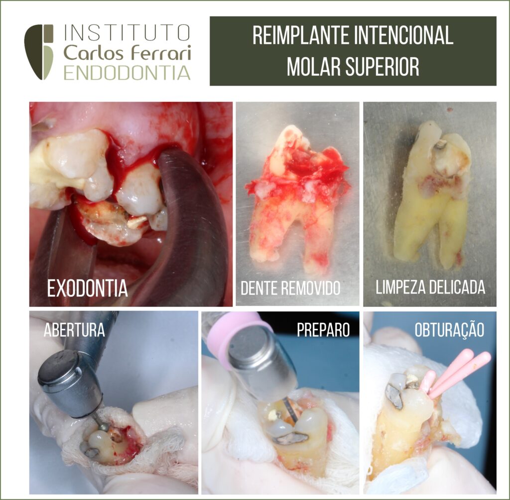 Intentional replantation