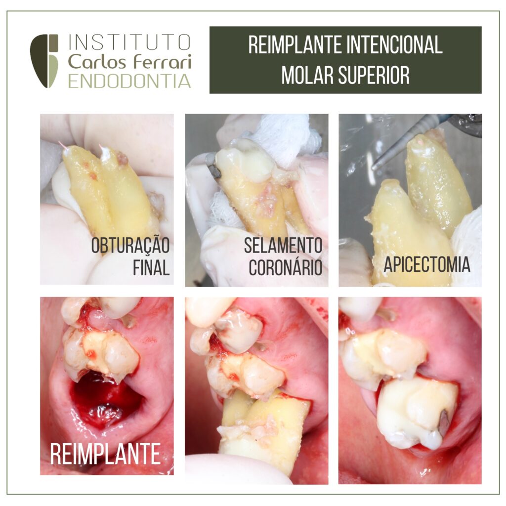 Intentional replantation