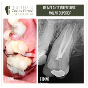 Leia mais sobre o artigo Transplante dental. Reimplante intencional.