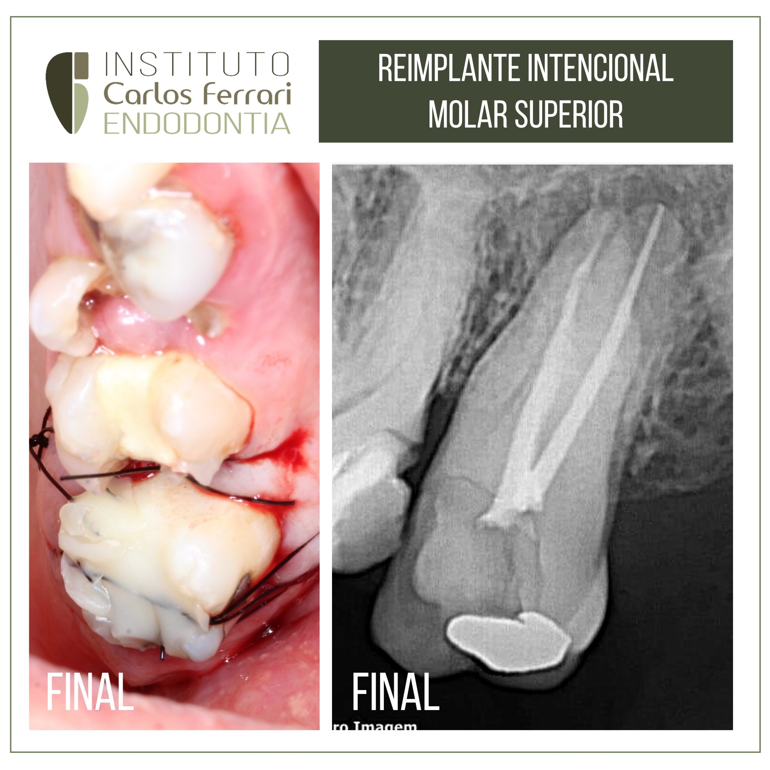 You are currently viewing Tooth transplantation. Intentional replantation.