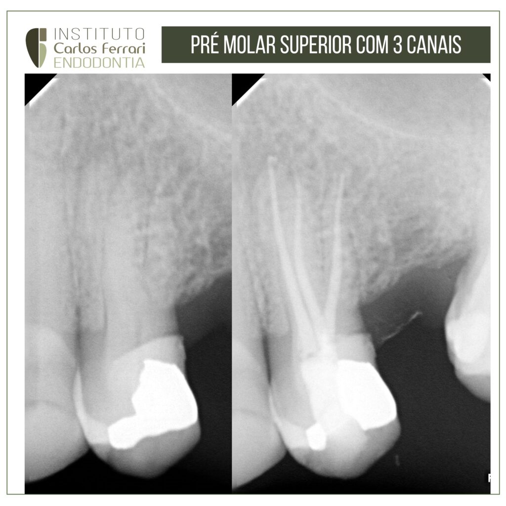 Leia mais sobre o artigo Pré-molar superior com três raízes e três canais.