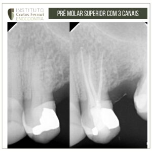 Read more about the article Pré-molar superior com três raízes e três canais.