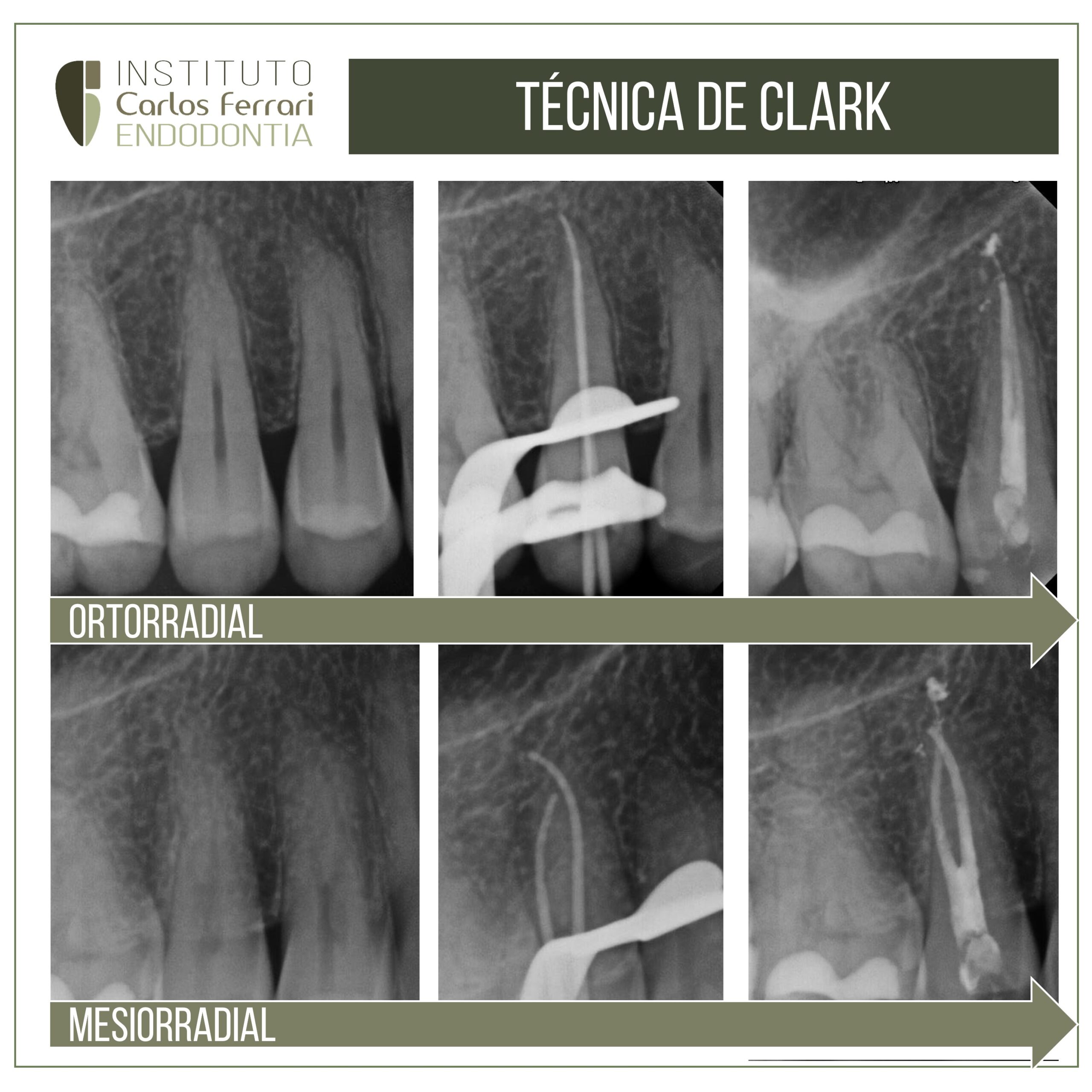 You are currently viewing Técnica de Clark na endodontia.