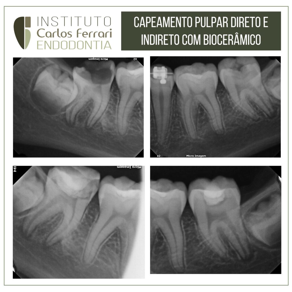 capeamento pulpar direto e indireto com biocerâmico