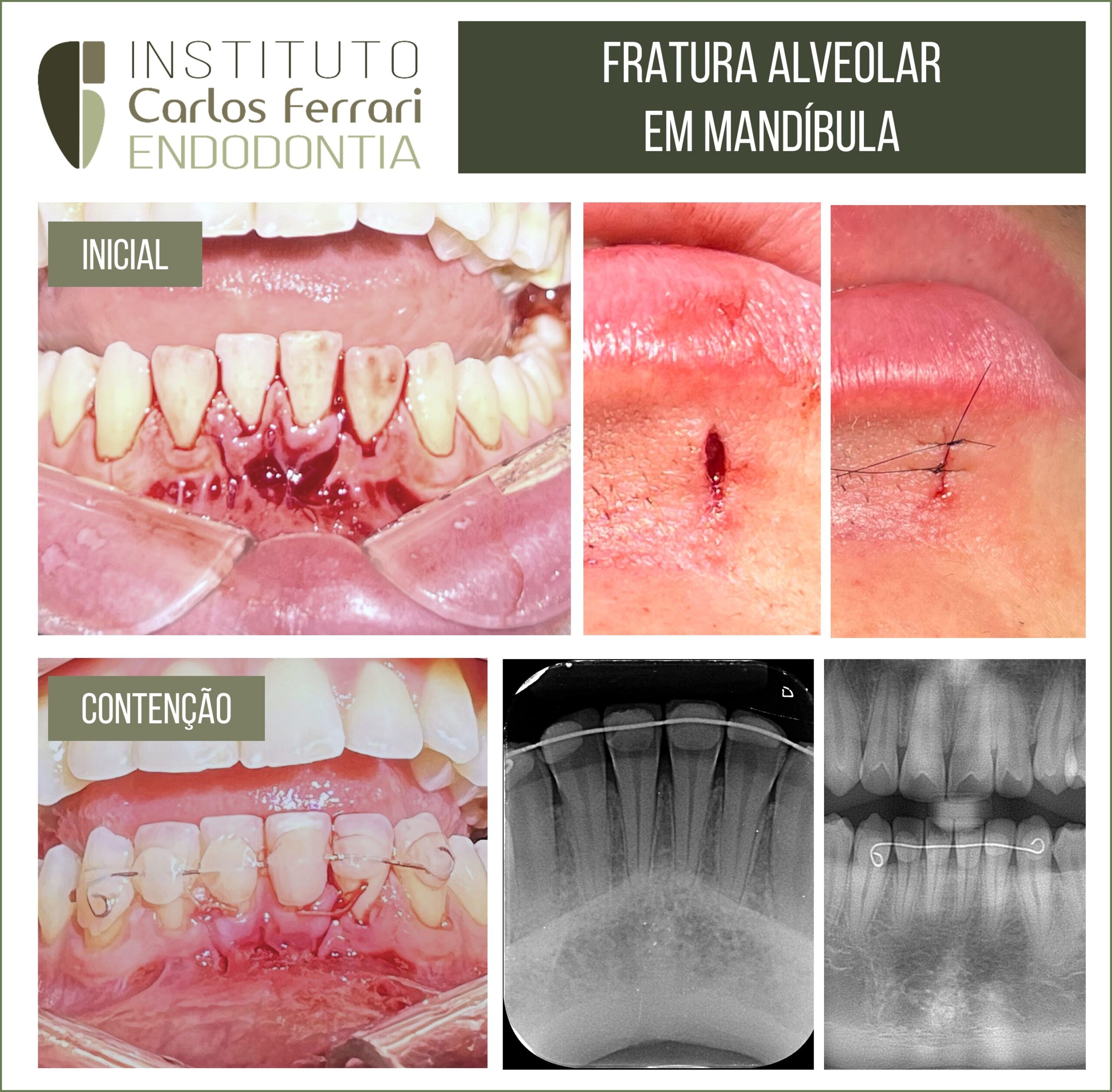 No momento, você está visualizando Fratura alveolar. Trauma no esporte.