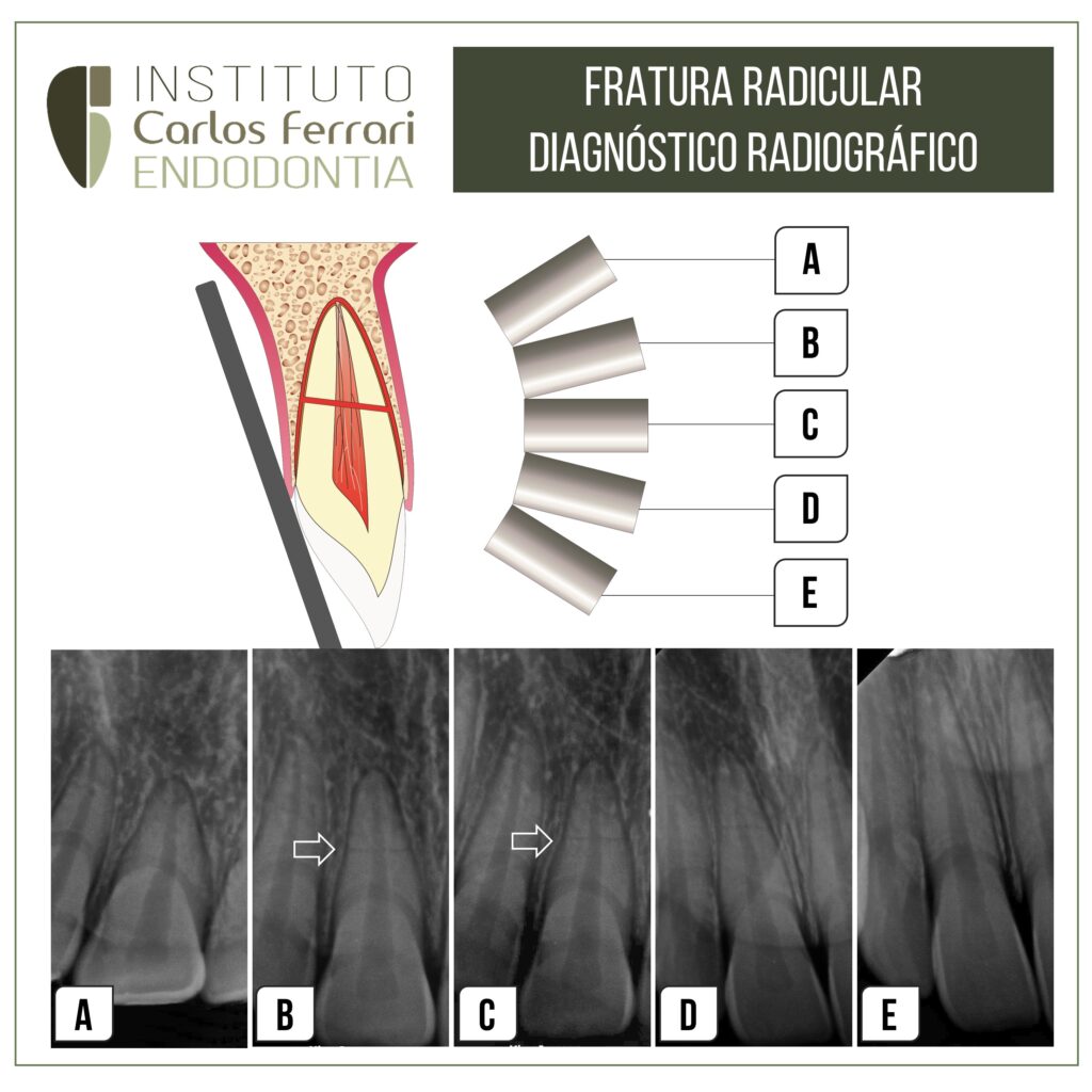 Leia mais sobre o artigo Fratura radicular. Diagnóstico radiográfico.