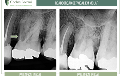 Reabsorção cervical.