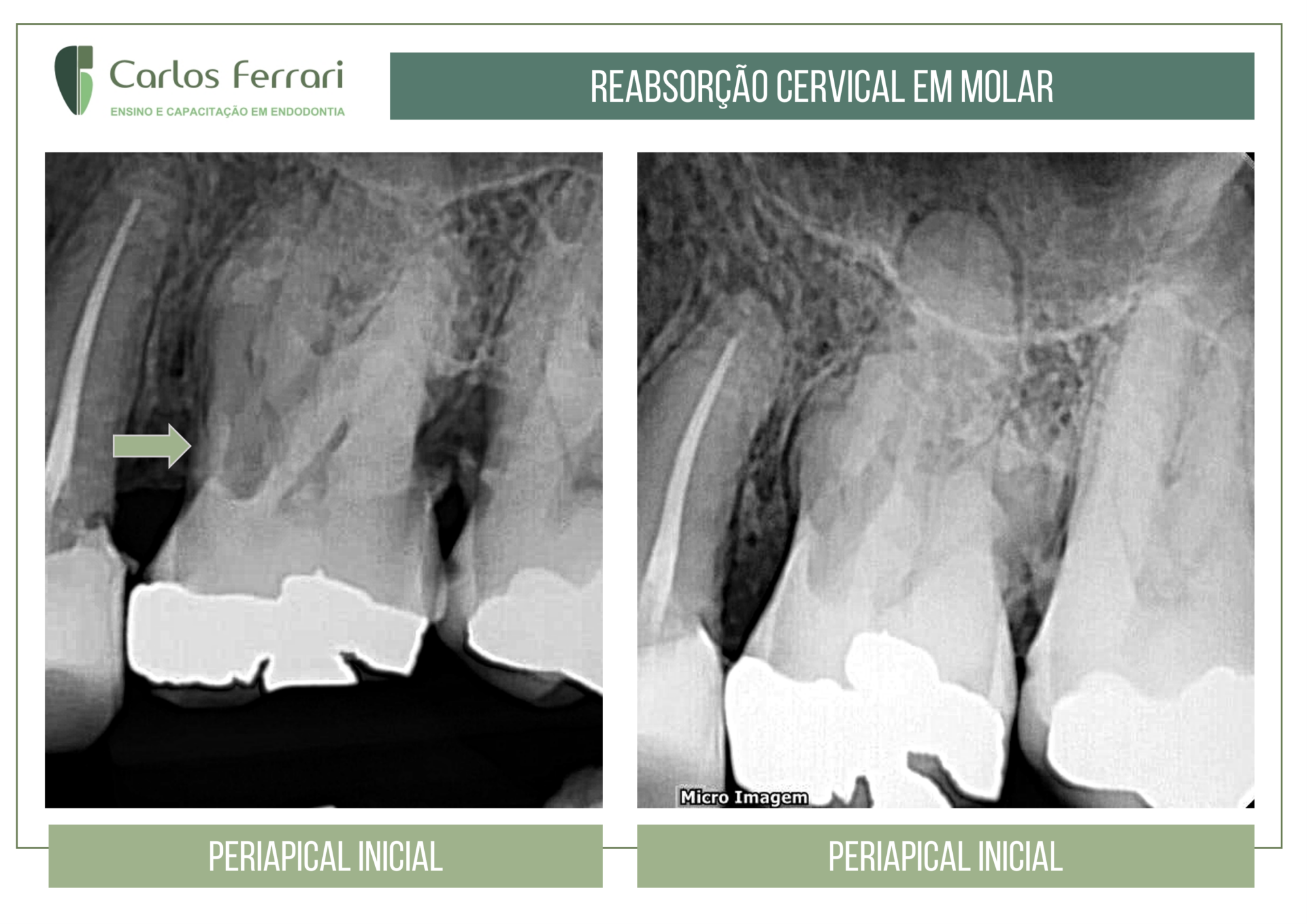 Reabsorção cervical.