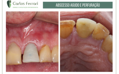 Perfuração radicular tratada com cirurgia paraendodôntica