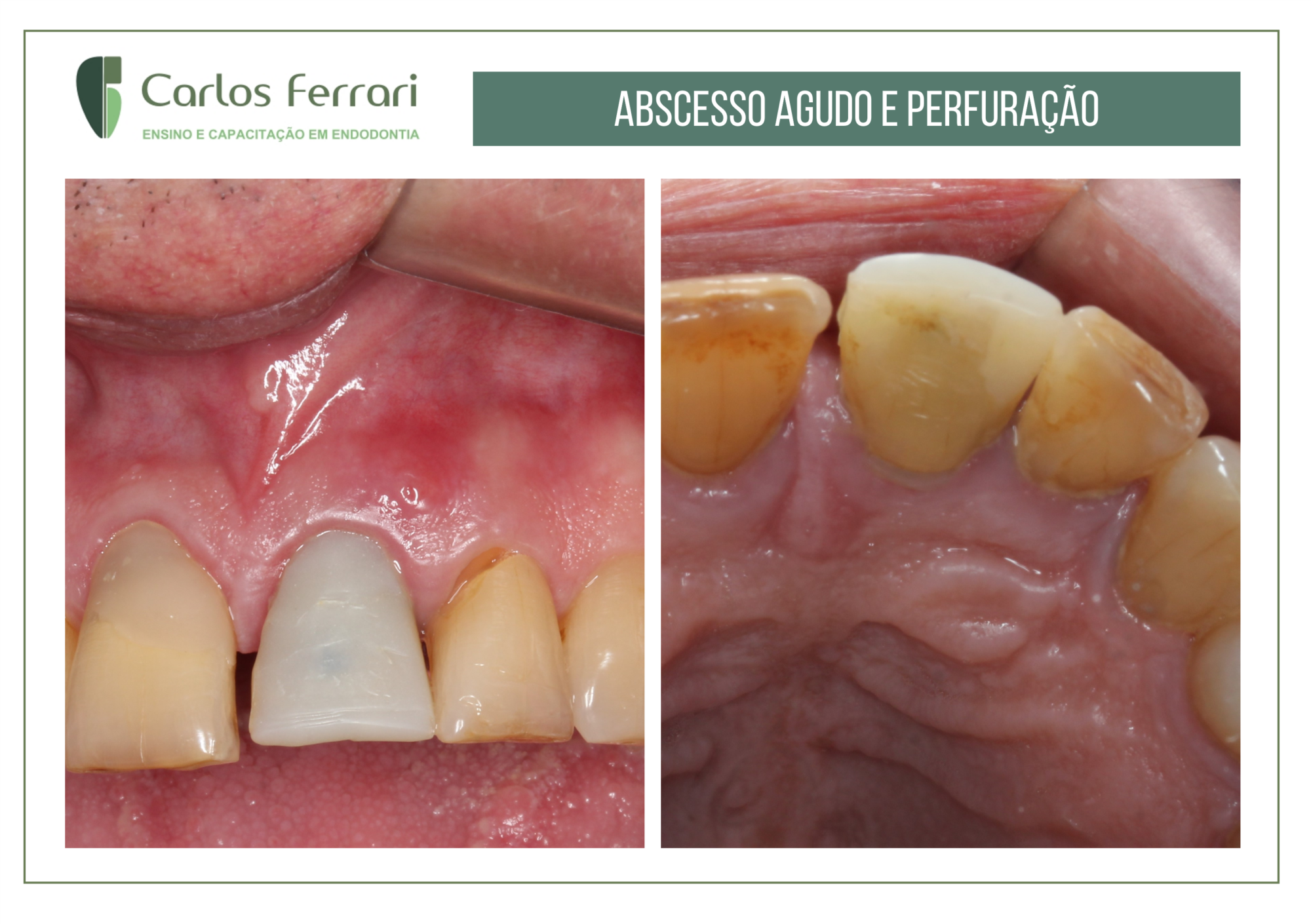 Perfuração radicular tratada com cirurgia paraendodôntica
