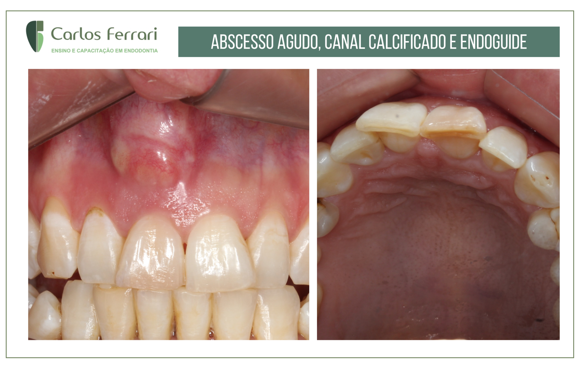 Abscesso periapical agudo e canal calcificado.