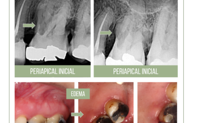 Reimplante intencional em molar com reabsorção radicular.