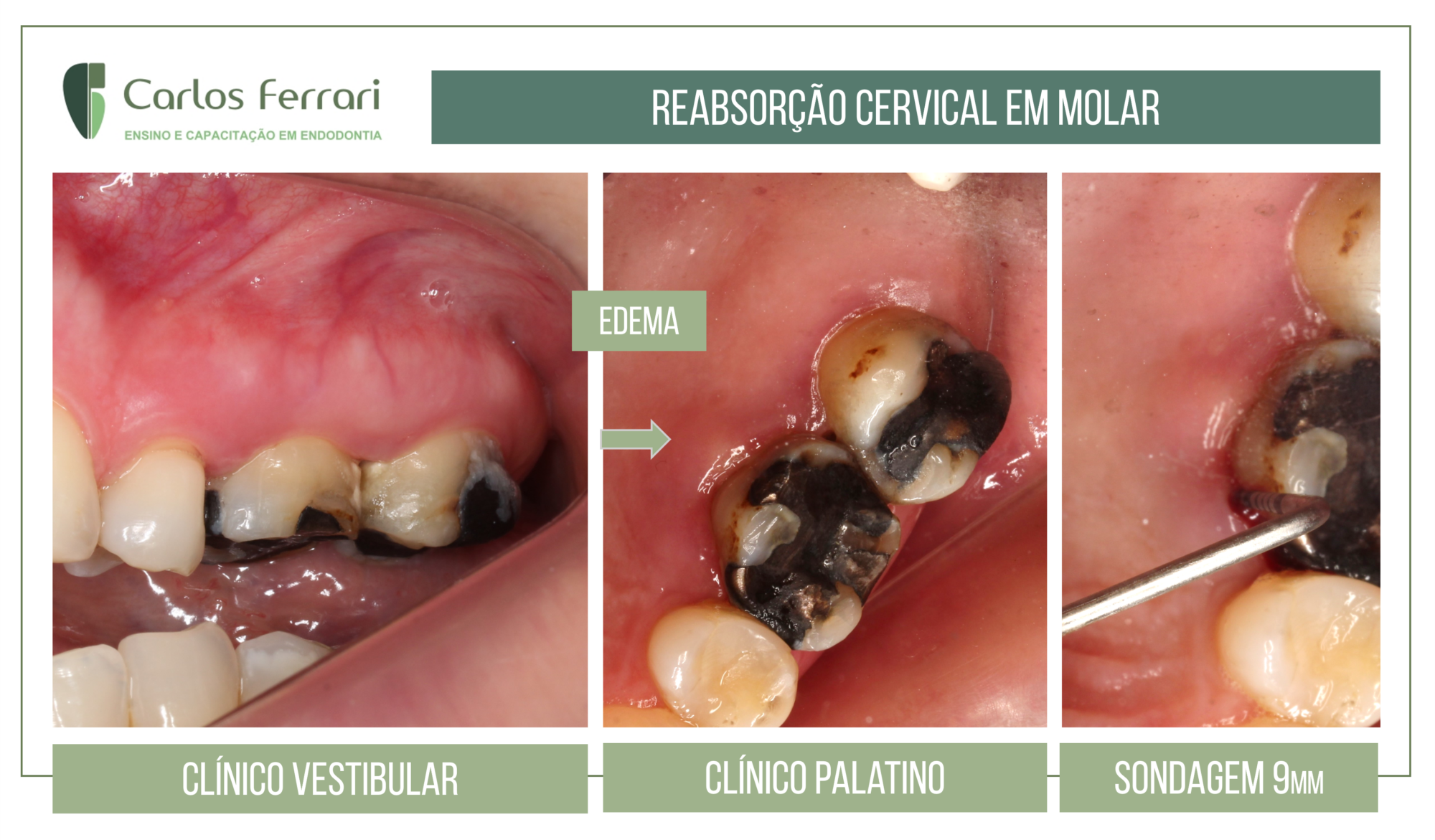 Reabsorção cervical.