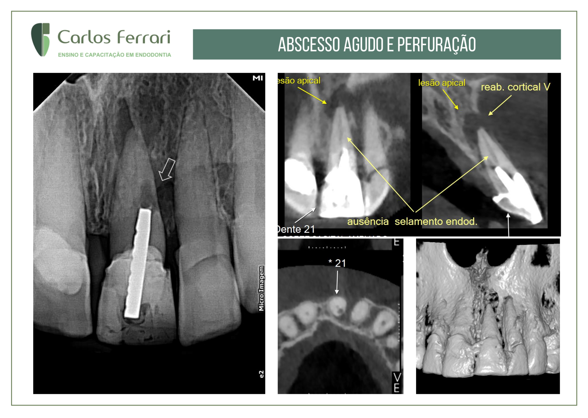 Perfuração radicular tratada com cirurgia paraendodôntica