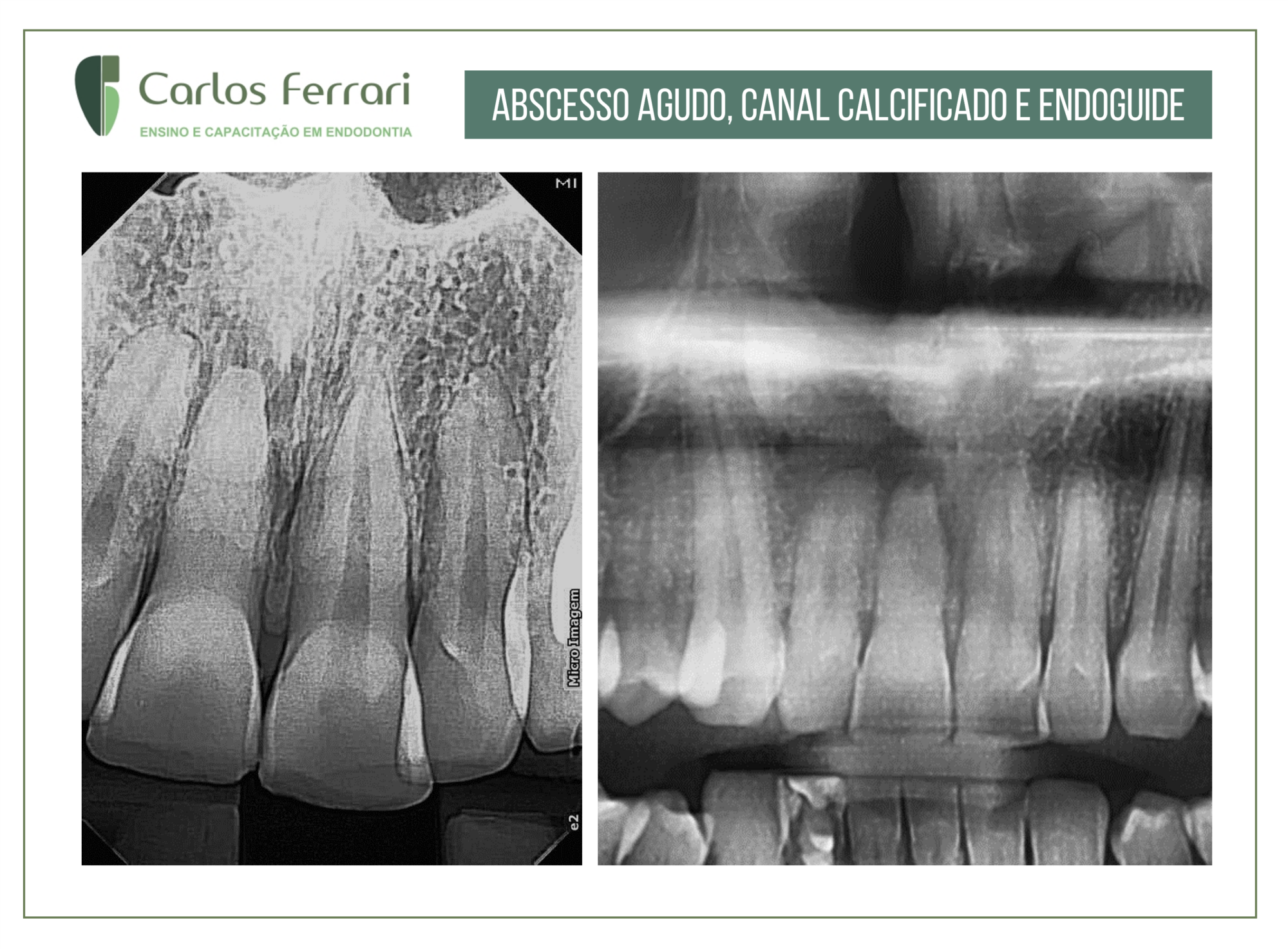 Abscesso periapical agudo e canal calcificado.