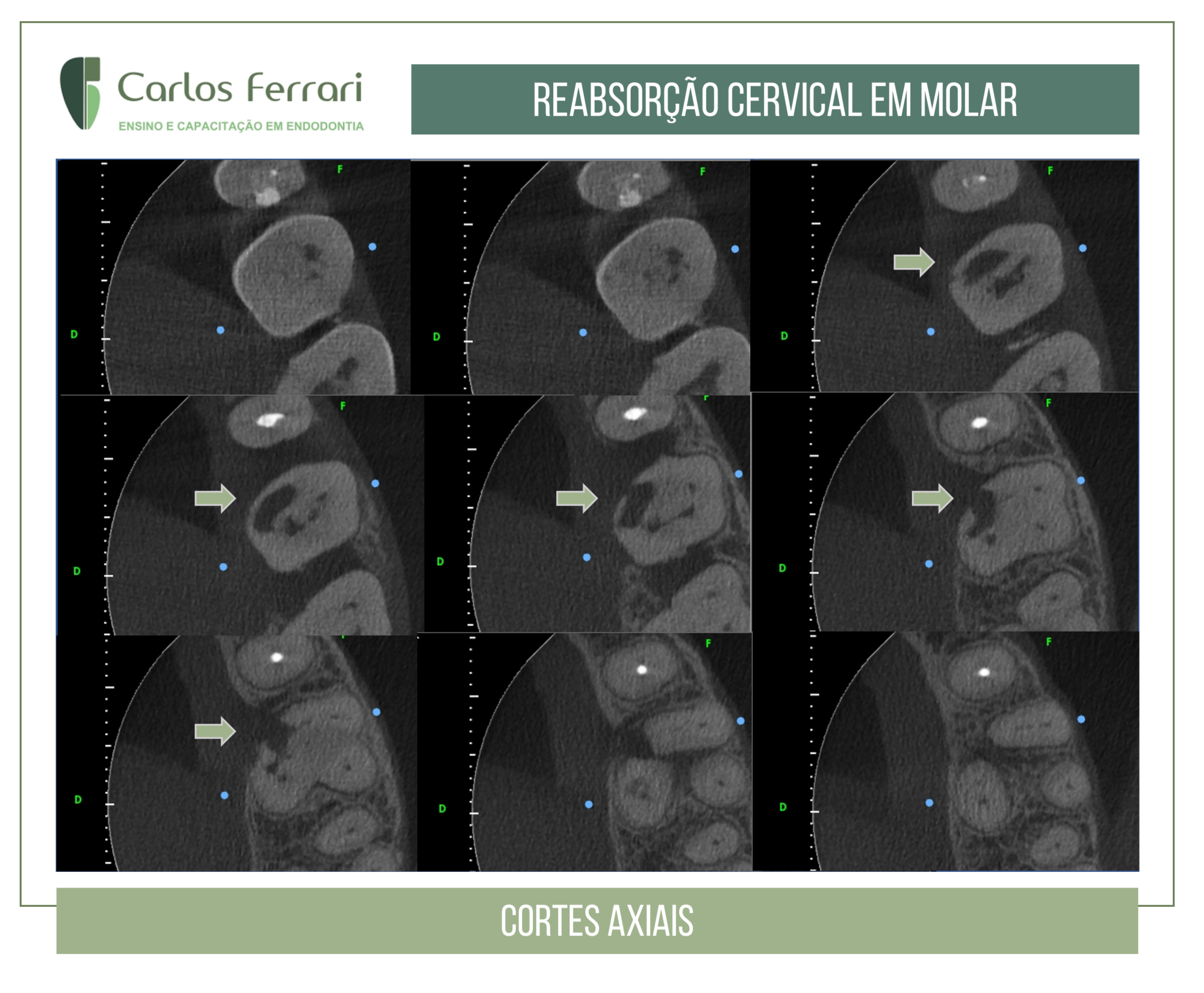 Reabsorção cervical.