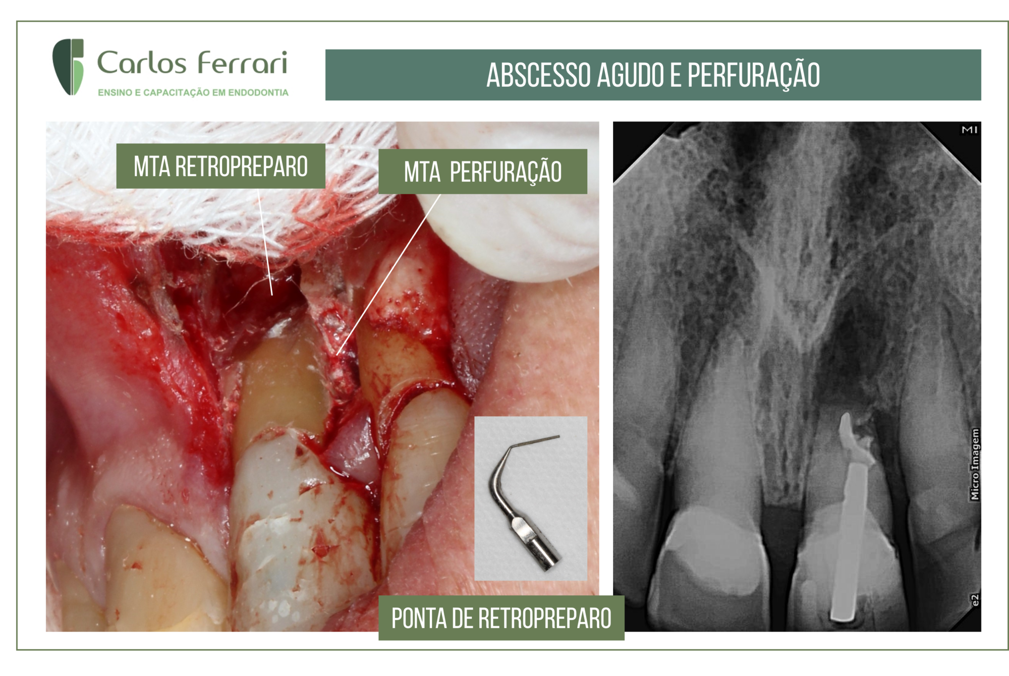 Perfuração radicular tratada com cirurgia paraendodôntica