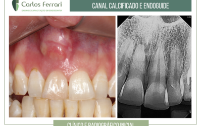 Endoguide em canal calcificado