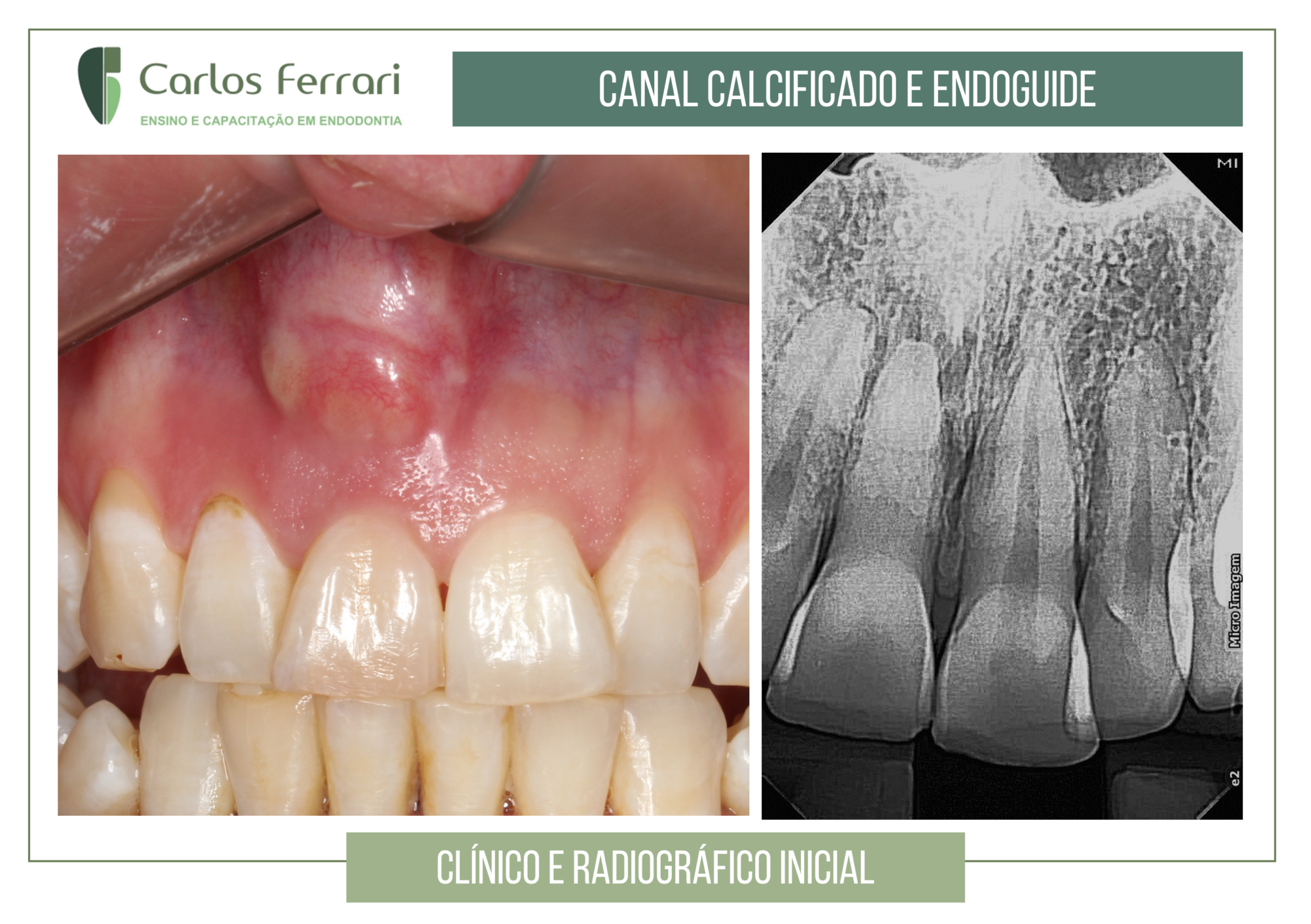 Endoguide em canal calcificado